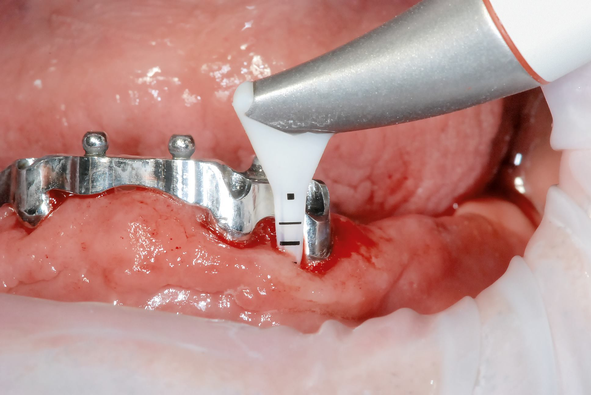 implant 4 implant 4