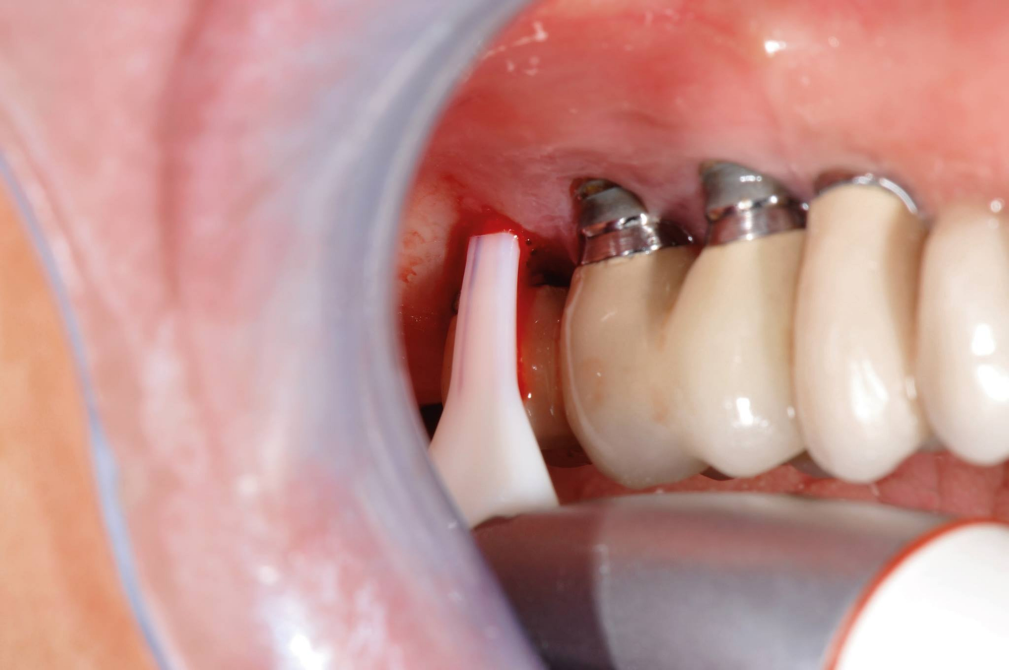implant 2 implant 2
