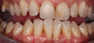 GBT against Plaque - After GBT GBT against Plaque - After GBT