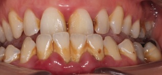 GBT against Plaque - Before GBT GBT against Plaque - Before GBT